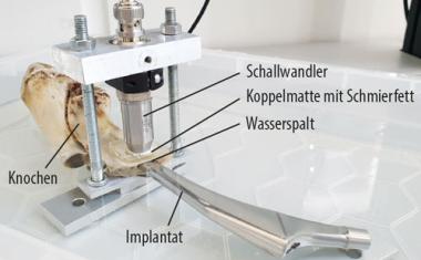 Hüftschäden quantifizieren