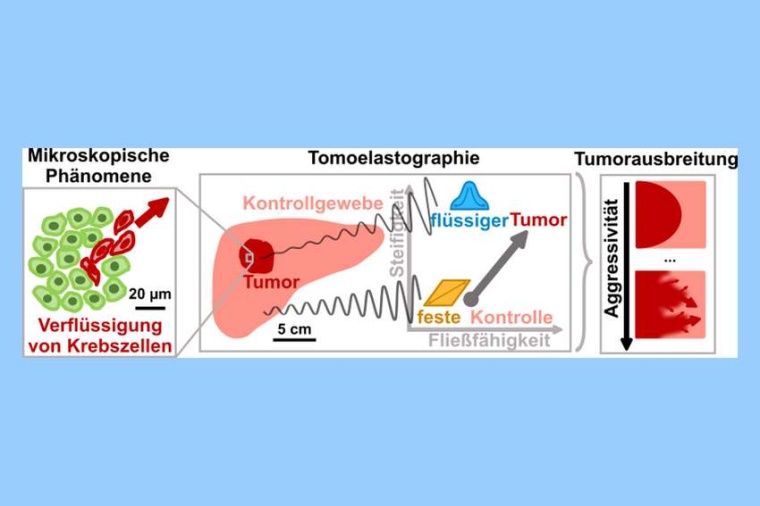 Abb.: Tumor­asso­zi­ierte mikro­sko­pische Effekte wie die...